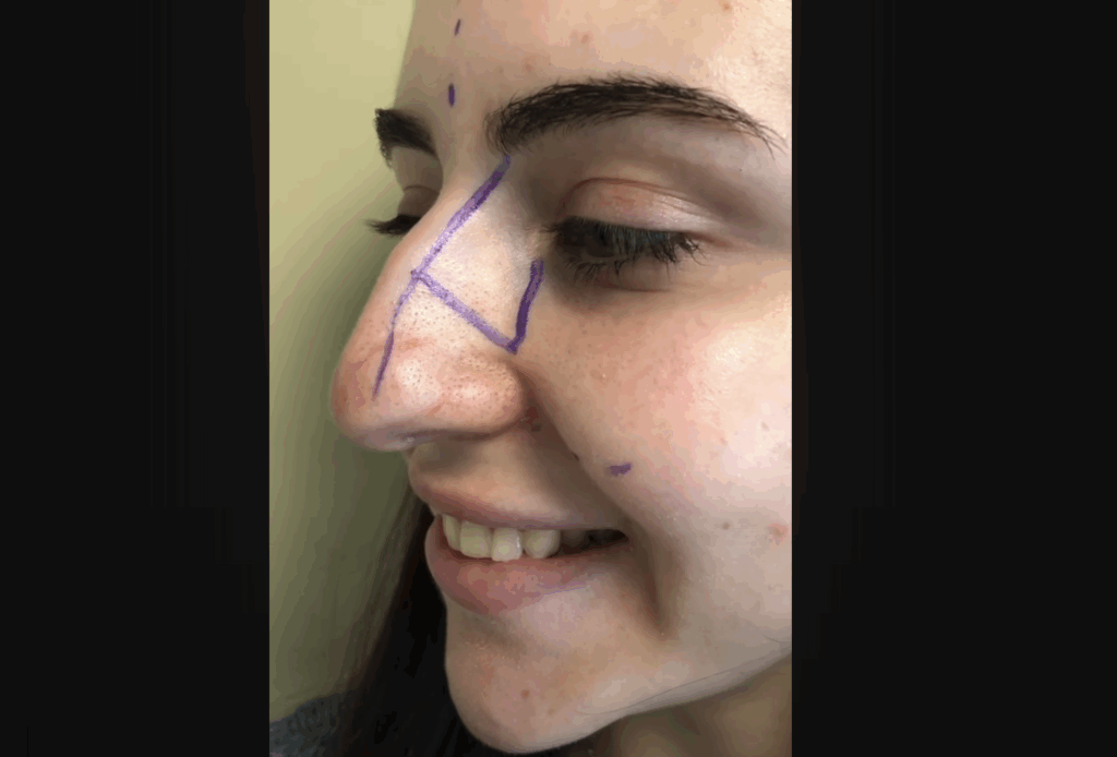 Sa Rhinoplastie a Tout Changé—Le Avant/Après est Incroyable