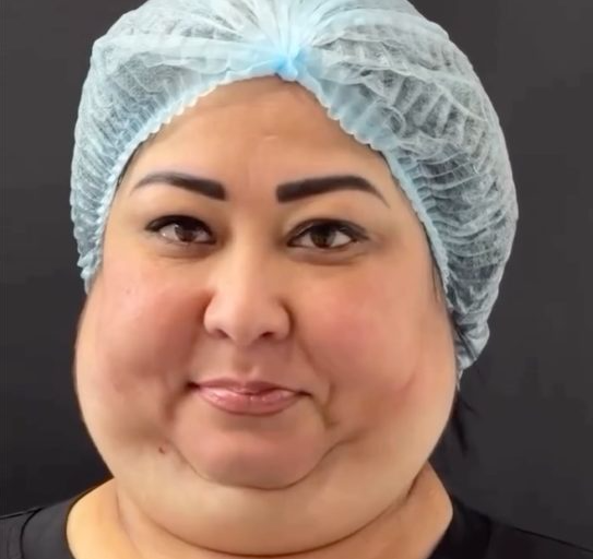 She Finally Revealed Her Jawline—The Before & After Is Incredible